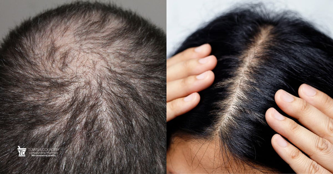 Revolutionizing Hair Loss in Men and Women: Low-Dose Oral Minoxidil (LDOM)